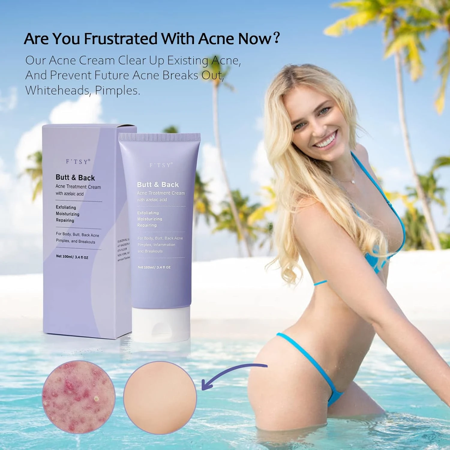 Private Label Acne Treatment Butt Acne Clearing Face Azelaic Acid Acne Cystic Scar Treatment Hormonal Cream