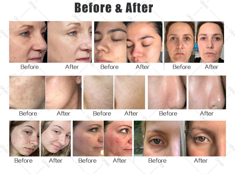 wholesale Multi-Function Beauty Equipment Facial Hydrodermabrasion Peeling Microdermabrasion facial spa machine