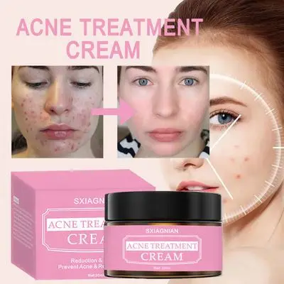 SXIAGNIAN  Natural Fast Effective High Quality Benzoyl Peroxide 10% Anti Acne Face Cream
