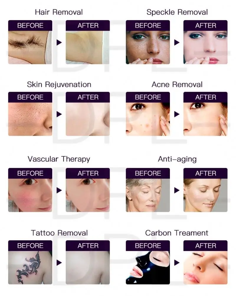 DPL Tattoo Removal Machine 3 IN 1 Multiifunction Laser IPL OPT Hair Removal Facial RF Acne Treatment Skin rejuvenation machine