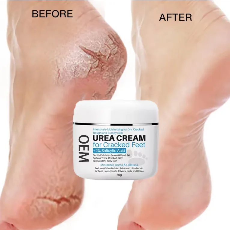 2% salicylic Acid Dead skin removal exfoliating treatment for cracked heels urea 40% foot cream hand and foot cream