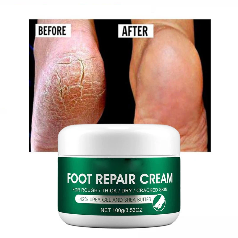 Anti Fungal Foot Repair Foot Cream Dead Skin Removal Peeling Moisturizing Exfoliation Foot Care Repair Cream For Cracked Heels