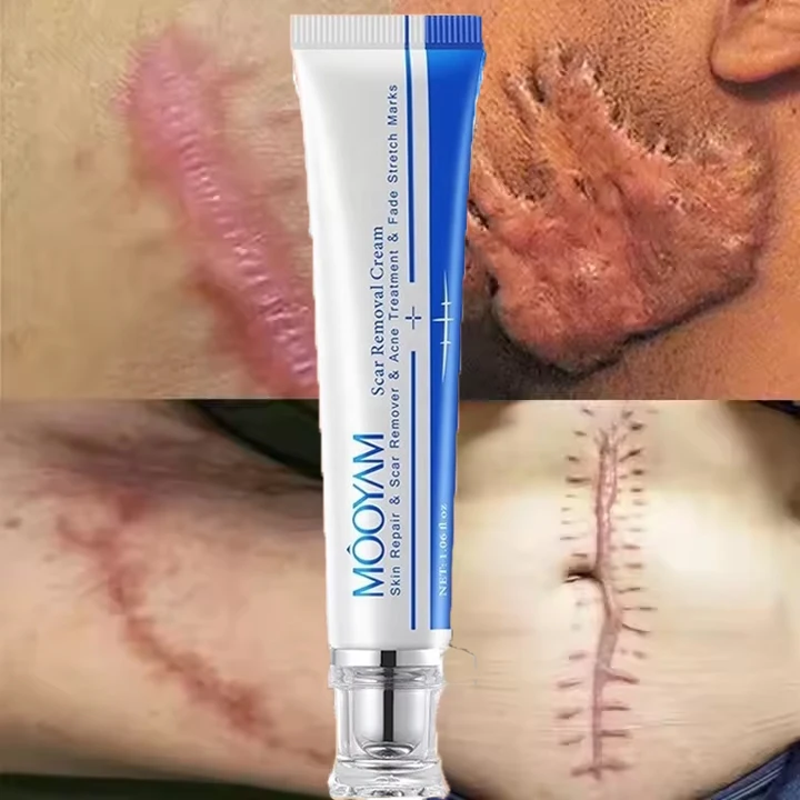 Private Label Free Sample Face Skin Stretch Marks Relief Burns Repair Cream Scar Removal Cream Scar Cream For Old Scars