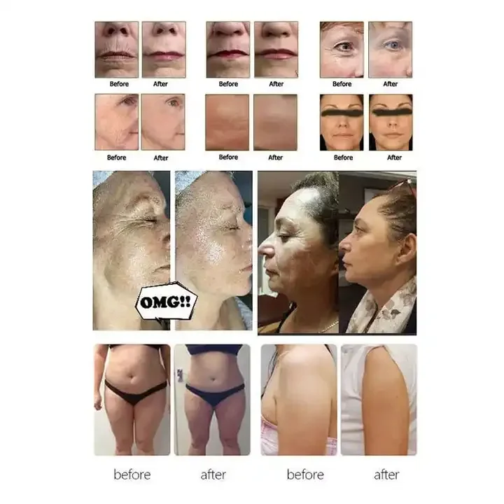 10 cartridges Lip handles skin tightening firming machine Hi-fu facial wrinkle removal device