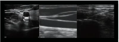 linear portable ultrasound diagnosis equipment with needle biopsy guide