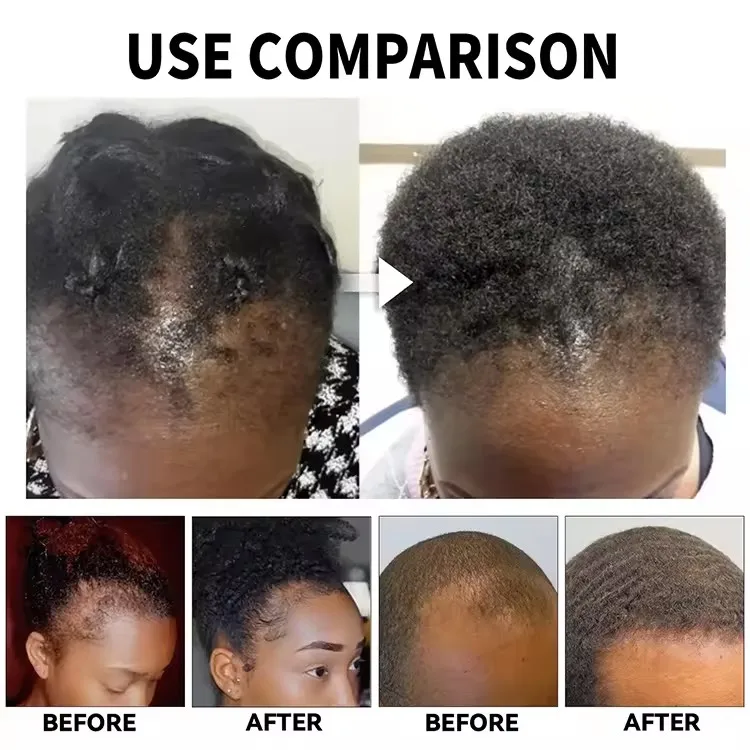 African All Natural Hair Treatment Products Miracle Rosemary Mint Hair Growth Oil Serum for African Hair Natural Babies