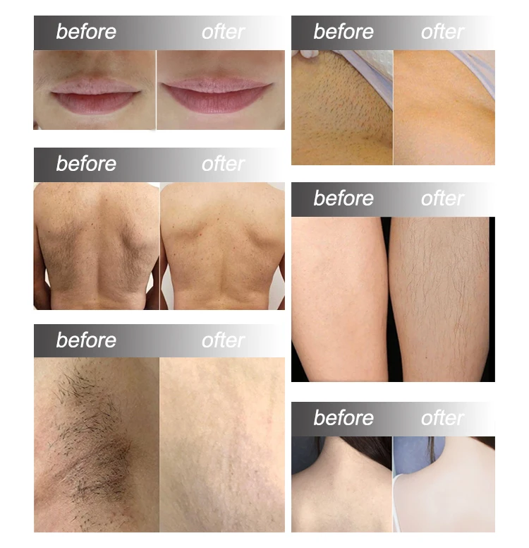 cost effective triple wavelengths 808+755+1064 epliation diode laser hair removal machine beauty machine