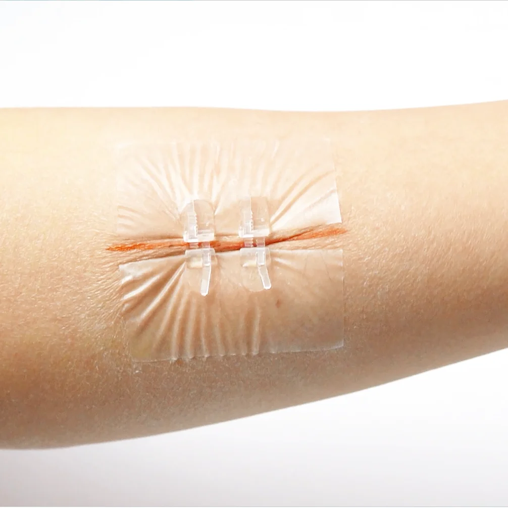Прозрачное устройство для безболезненного закрытия ран на молнии