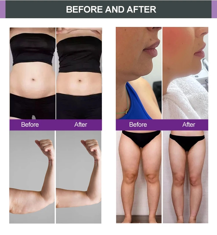 Newangie Popular Selling Trusculpt Id And Flex Slimming Face Lifting Body Rejuvenation Body Shaping Trusculpt Rf Machine