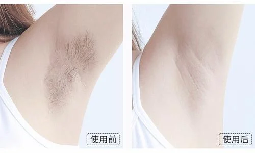 Laser Hair Removal For Women Men 300000 Flashes Painless Ipl Laser Hair Removal Appliance With Cooling Function For Full Body