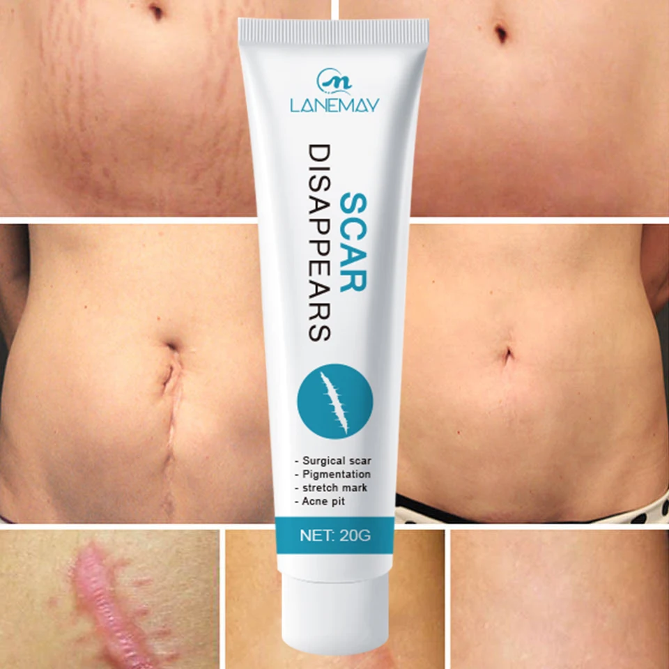 Strong Effective Acne Scar Removal Cream Pimples Stretch Marks Remove Face Gel Tummy Tuck Tightening Stretch Mark Removal Cream