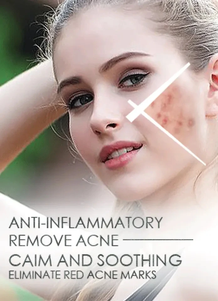 Private Label Anti Acne Cream Organic Herbal Dark Spot Repair Scar Remover Pimple Acne Cream