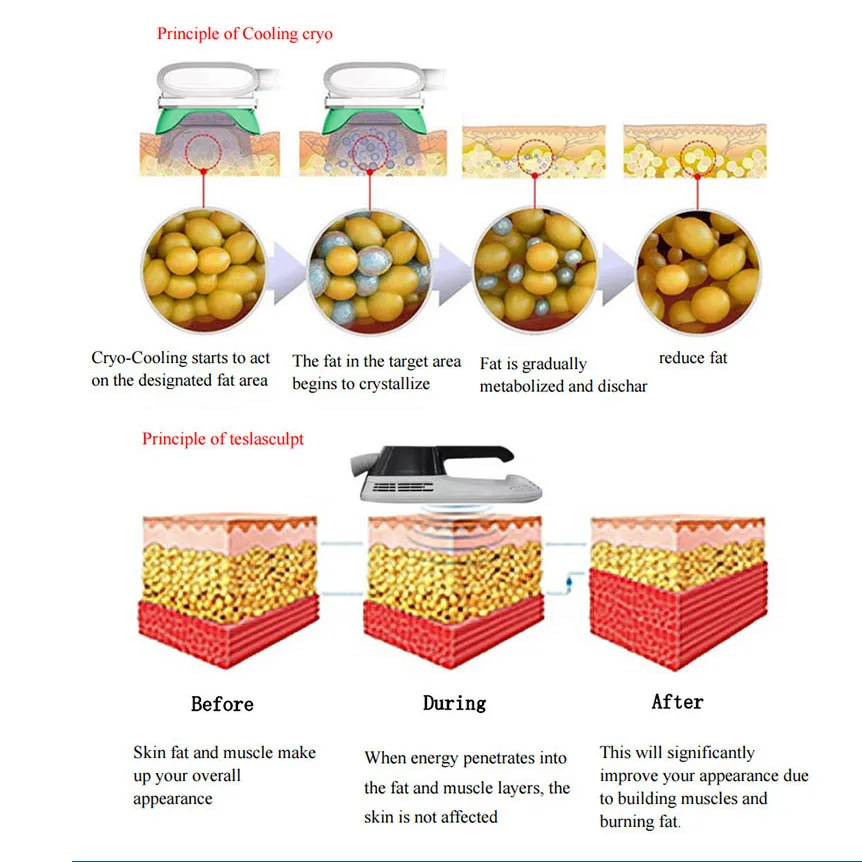 High intensity focused electromagnetic muscle stimulation cryolipolysis slimming machine