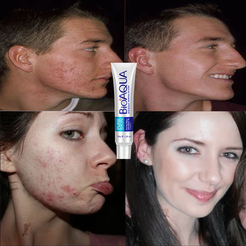 Whitening cream, acne removing   spot, moisturizing, autumn skin care products.