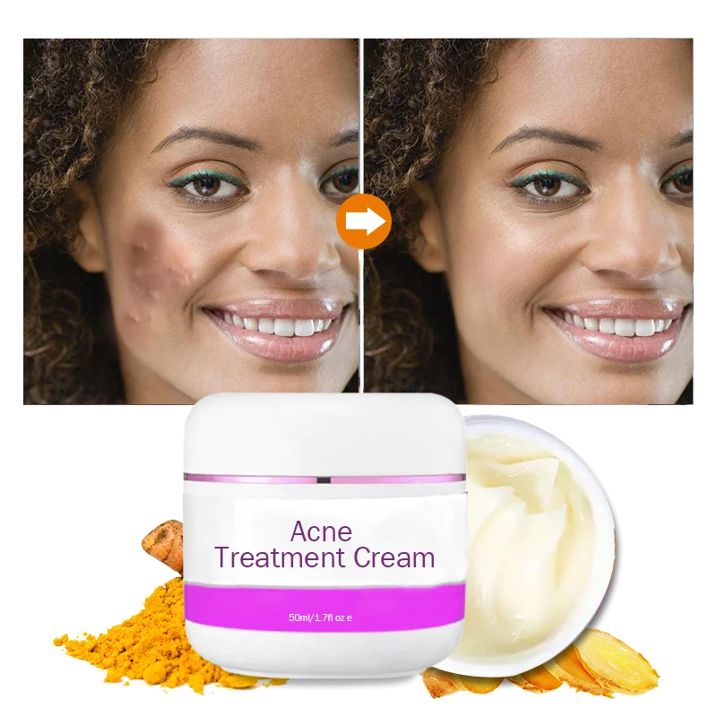 Acne treatment cream Super Lightening Kojic Arbutin Body Snow White Skin Care Intimate Whitening Cream For Sensitive Areas