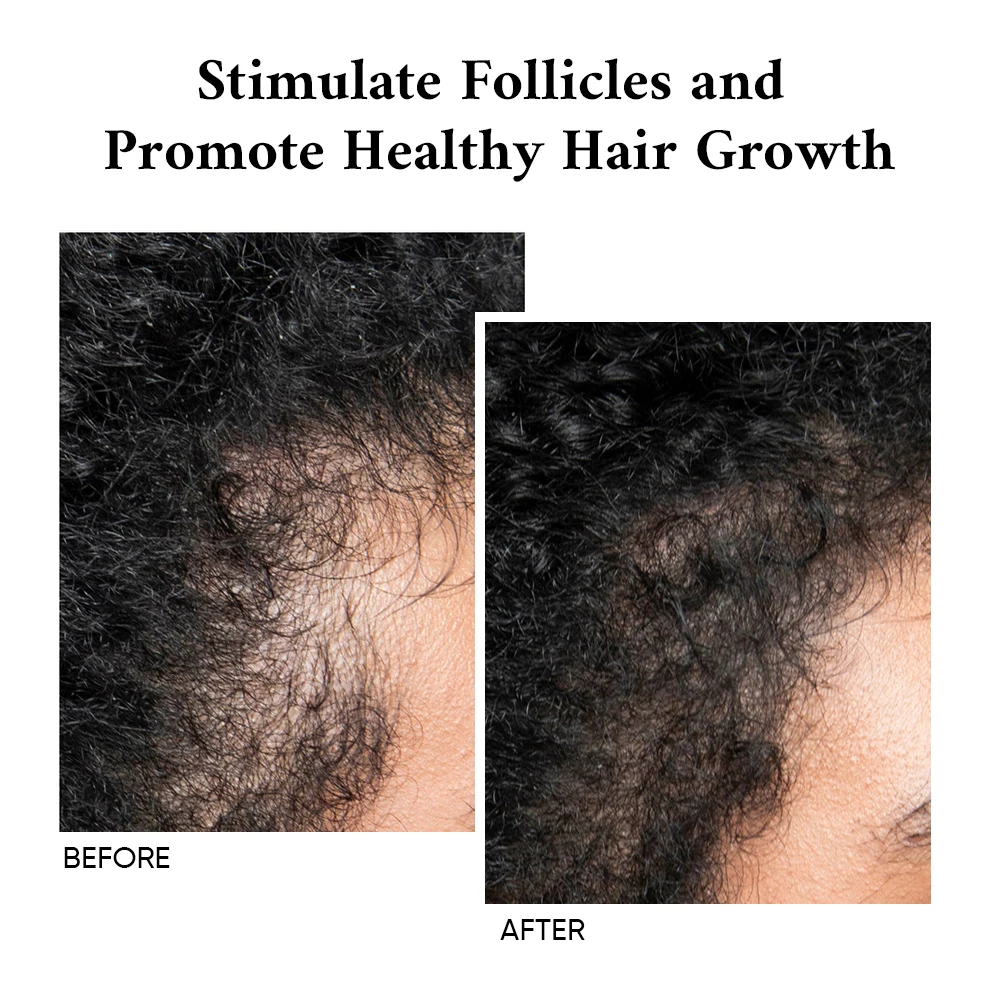 Oem Odm Natural Chia Seed Oil Stimulate Follicles Hair Loss Prevention Women And Men Regrowth Hair Tonic For Men Hair Growth