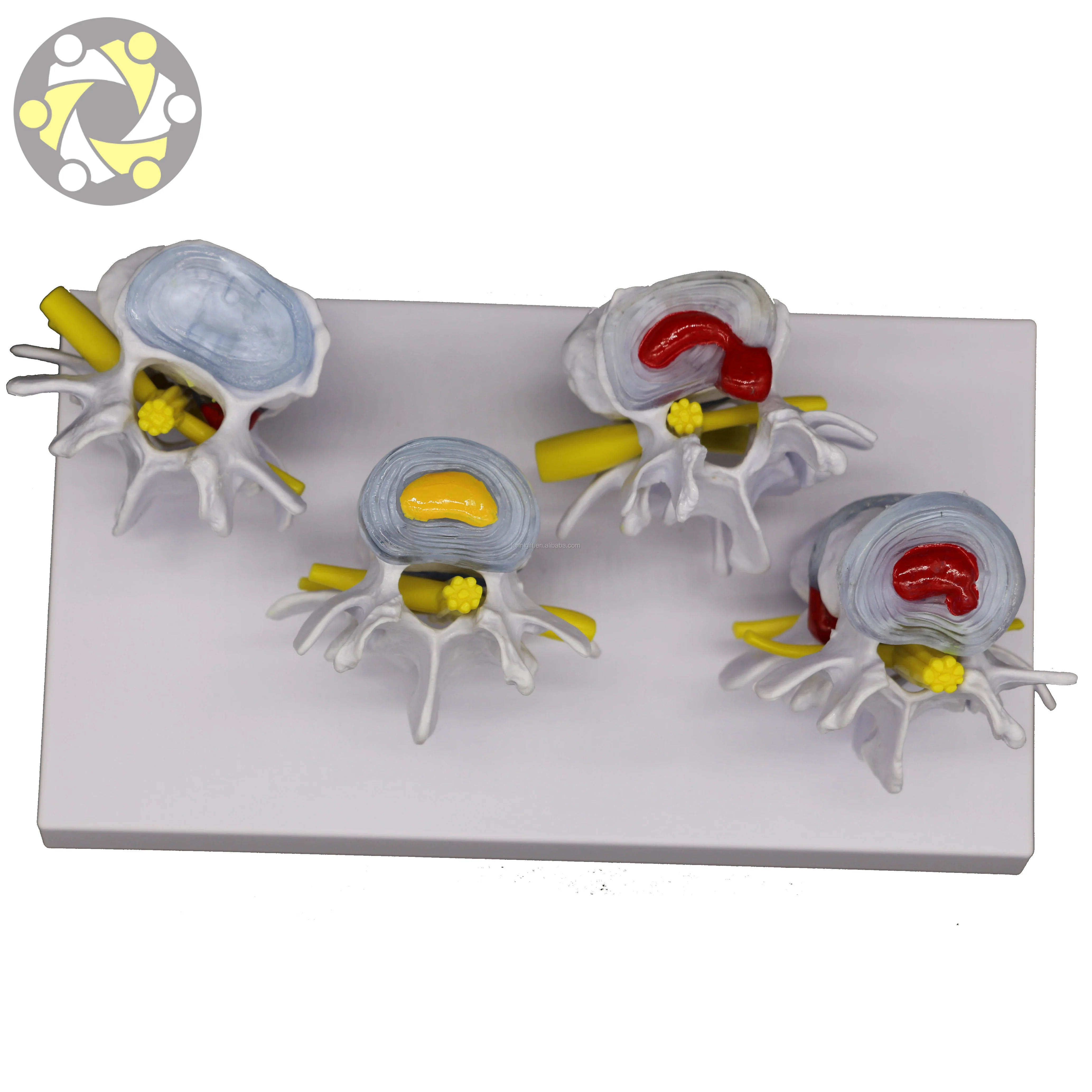 Medical Science 4 Stage Pathological Lumbar Skeleton Model