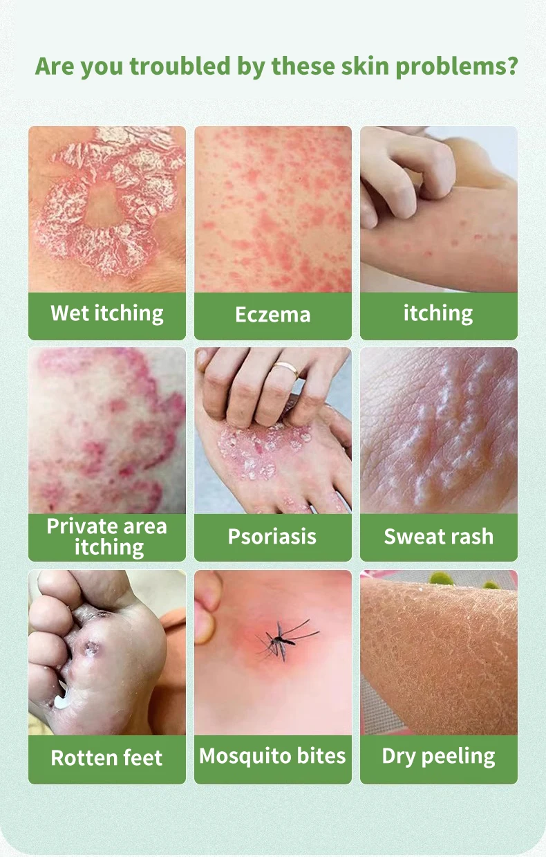 Wholesale Chinese Herbal Acne Antibacterial Ointment Manufacturers OEM Supply Daily Use for Body Skincare for Adults