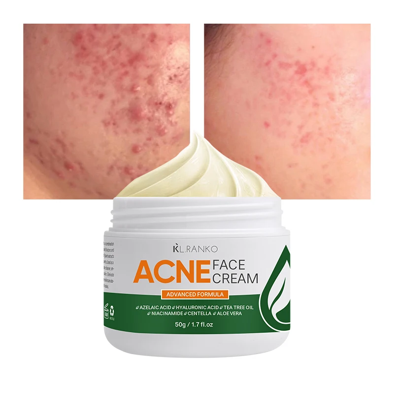 Wholesale Acne Mark Spots Face Cream Azelaic Acid Pimples Acne Marks Remover Repair Facial Creams Skin Care Products