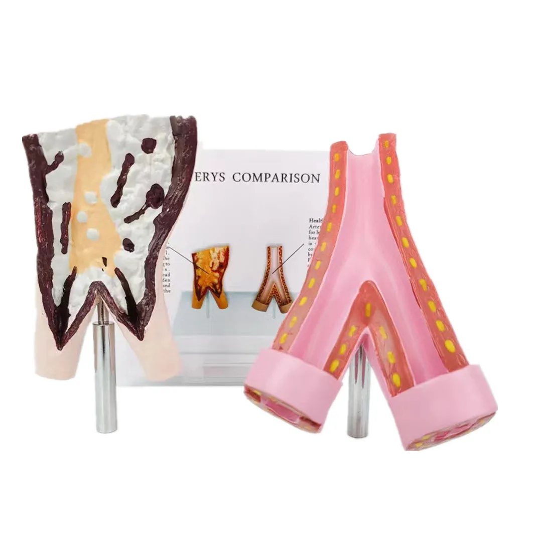 Medical Sciences Comparison Model Between Smoking Blood Vessels and Normal Blood Vessels  Artery Pathology Model