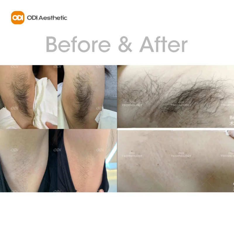 Top 3 IN 1 Diode Laser 2022 808Nm Laser Diode  808  Triple Wavelength Diode Laser