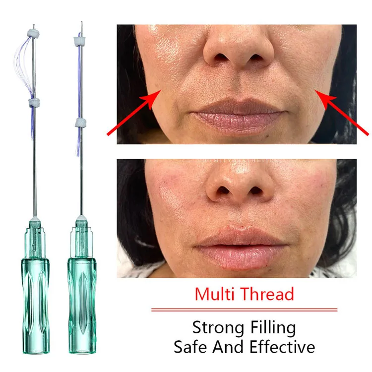 Double Needle Pdo Pcl Plla Thread Nose L Blunt Multi L Fish Bone L/W Blunt Molding Cog Pcl Mesh Thread for Facial Body Lifting