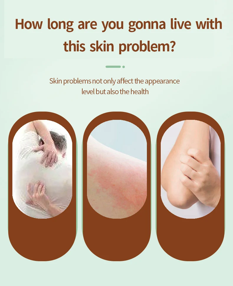 Anti-itching cream Provides Relief from Itching and Swelling for Mosquito Bites Insect Sting