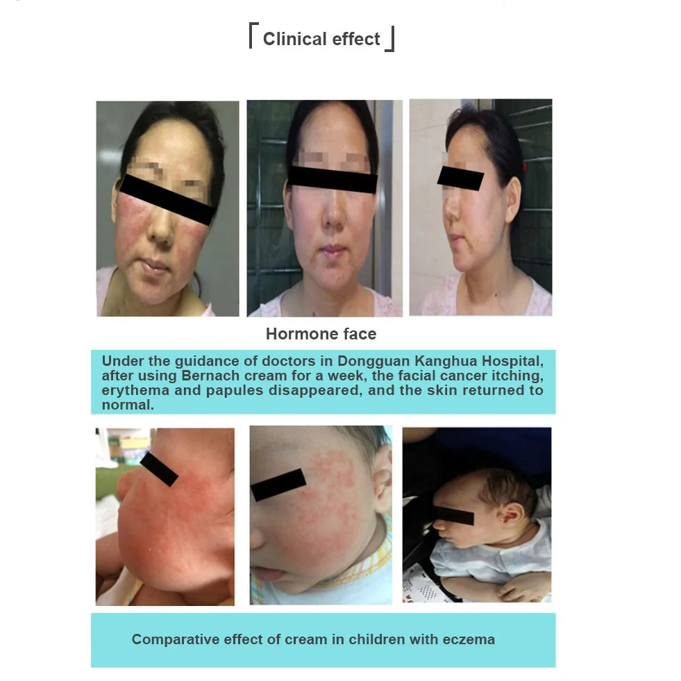 Medical Skincare Anti Acne Repair Facial Dermatitis and Barrier Damage Recombinant Humanized Type III Collagen Cream