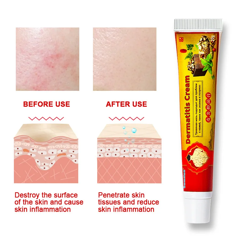 20g Psoriasis Cream Anti-Itching Eczema Treatment Herbal Medical Plaster Dermatitis Ointment Cream