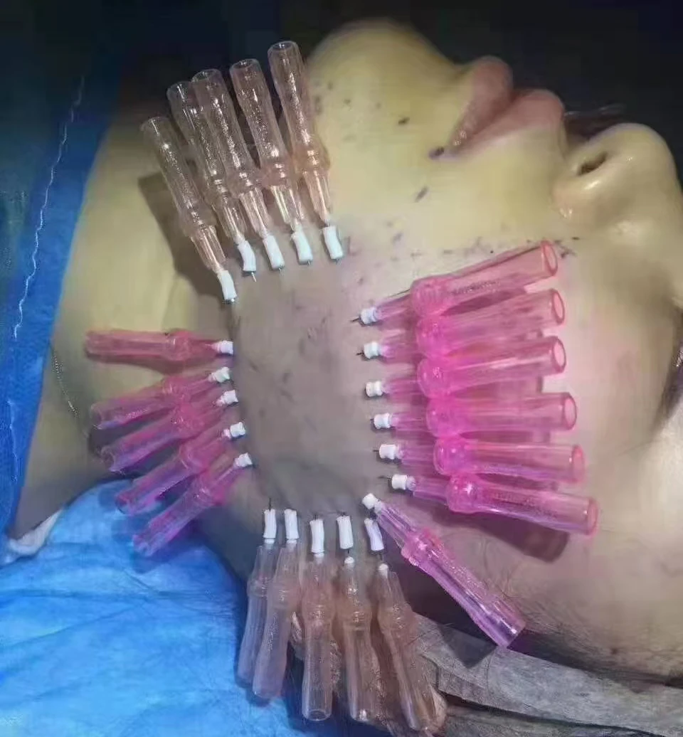 Hot Sale High Quality 27G 38mm Facelifting Facial Lifting Absorbable Tornado Thread Pdo