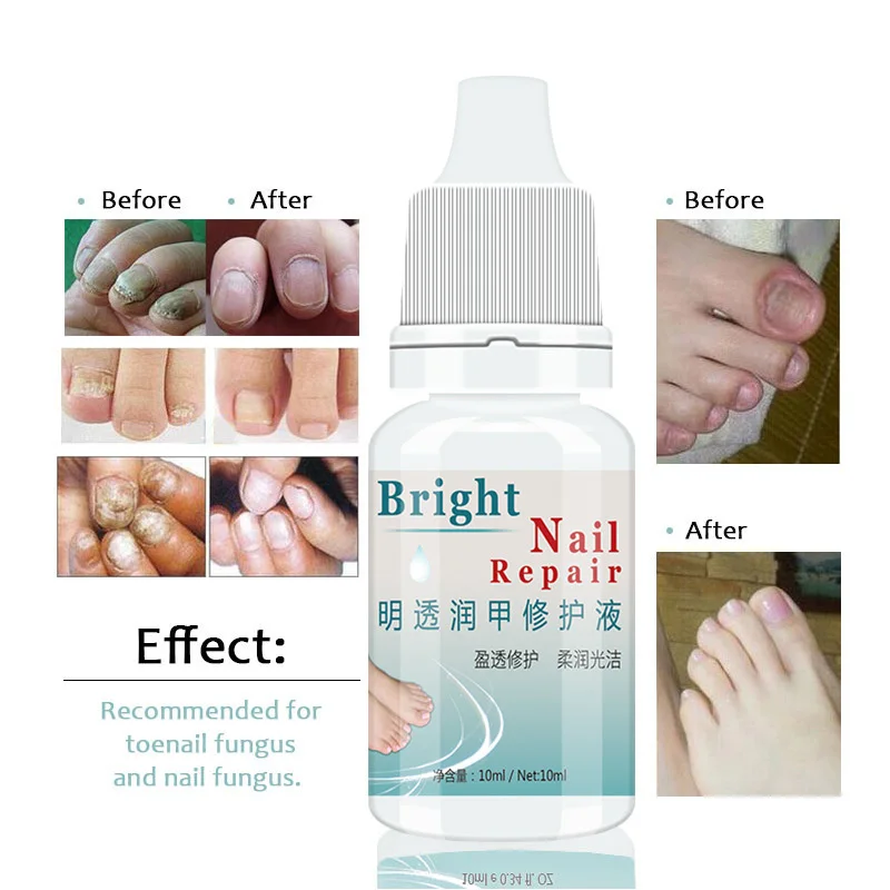 Fungal Repair Liquid Remove Onychomycosis Hand Foot Treatment Gel Infection Paronychia Hand Foot Care