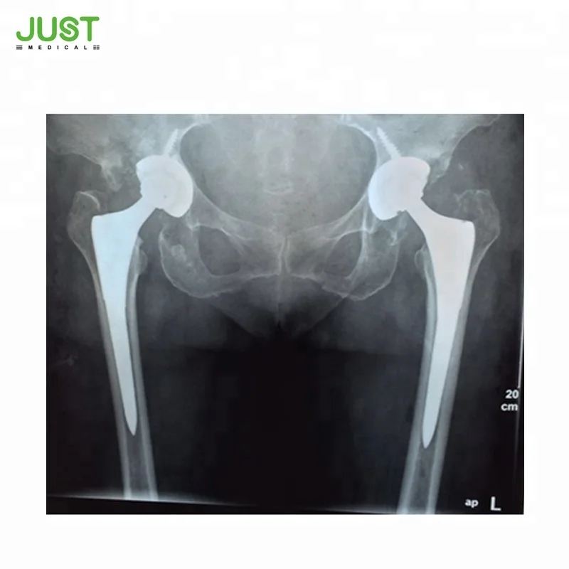 
Manufacture of titanium hip prosthesis femoral stem for total hip replacement 