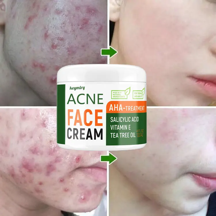 
Face Tea Tree Pimples And Dark Spot Removal Salicylic Acid Anti Scar Best Pimple Remove Acne Cream 