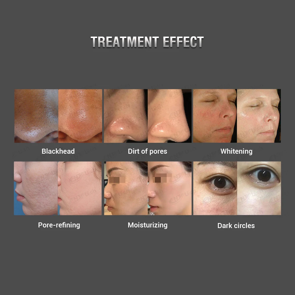 excellent results strong hydra skin facial 10 in 1 machine