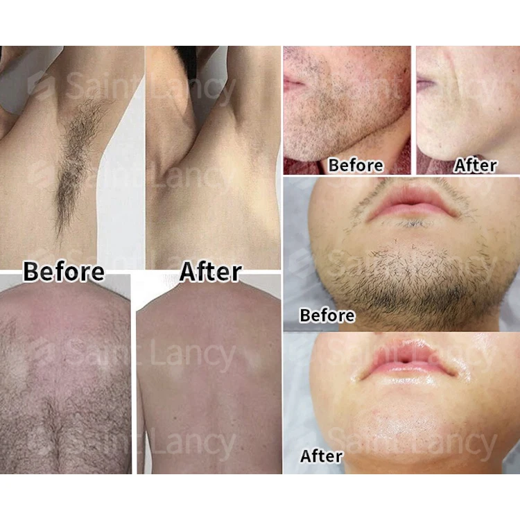 MLKJ 1200W 1600W ice Titanium/ diode Laser ice platinum/Triple wave 755 808 1064 diode laser hair removal machine price