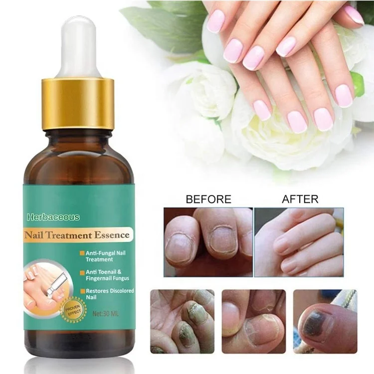 OEM Anti Fungal Treatment Finger Gel Beauty Care Nail