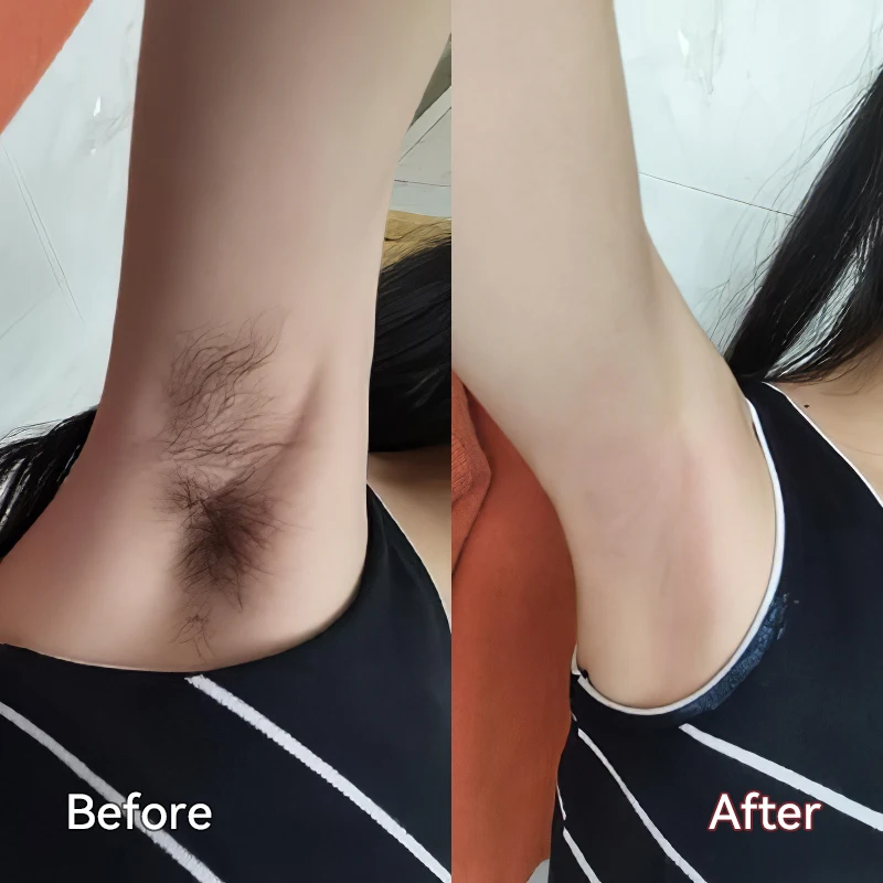 Permanent Hair Removal Machine Laser Hair Removal Machine Epilator for Home