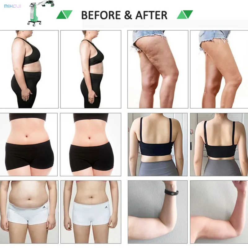 635nm Red Light 10D Maxlipo Master 532 nm Diode Cold Laser Fat Removal Machine