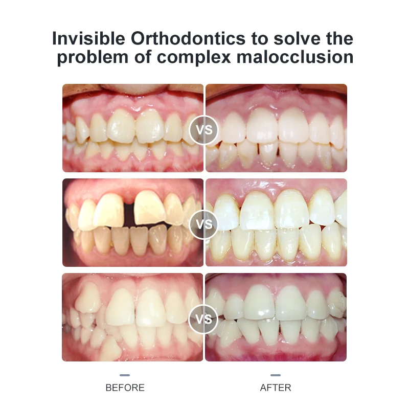 Professional Cost Of Aligners Teeth Invisalign Braces Manufacture Clear Aligner Set