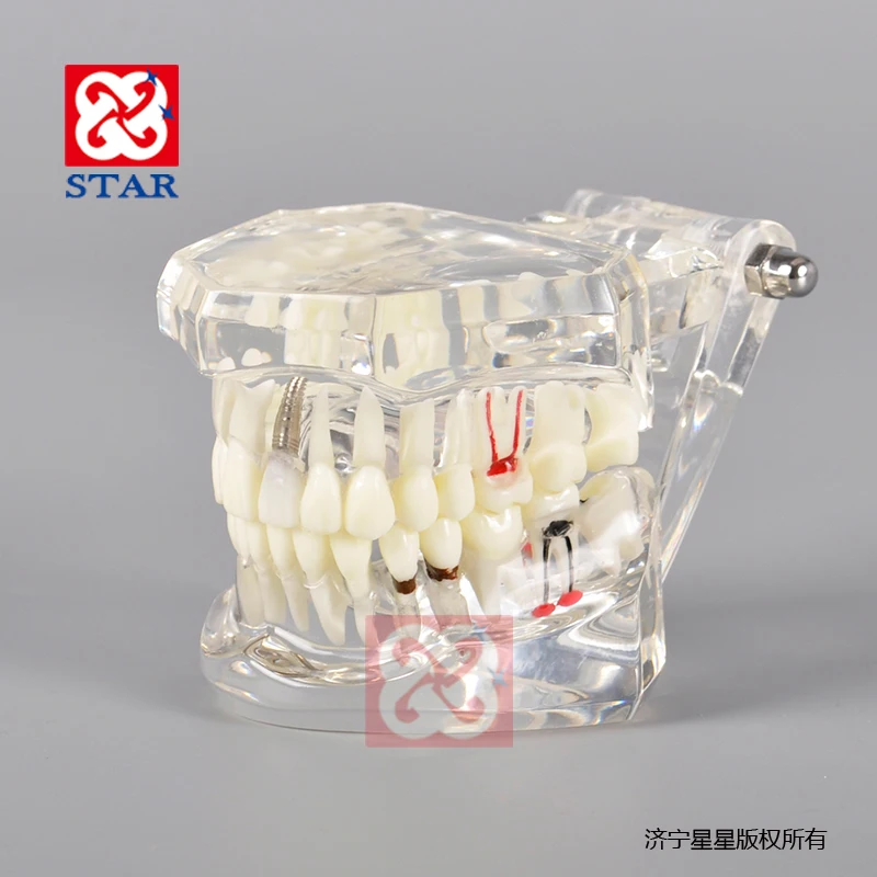 Implant restoration pathological dental model for demonstration
