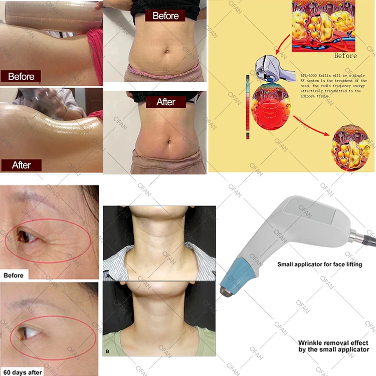 Eye bag removal ultrasound fat reducing skin tighten RF Protege 360 exili body sculpture bodi slim machine