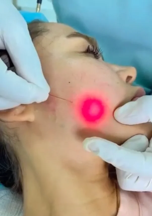 980nnm Professional Laser Liposuction Device Lipo Surgical Laser Device Endolaser face lift Laser For Body Shaping