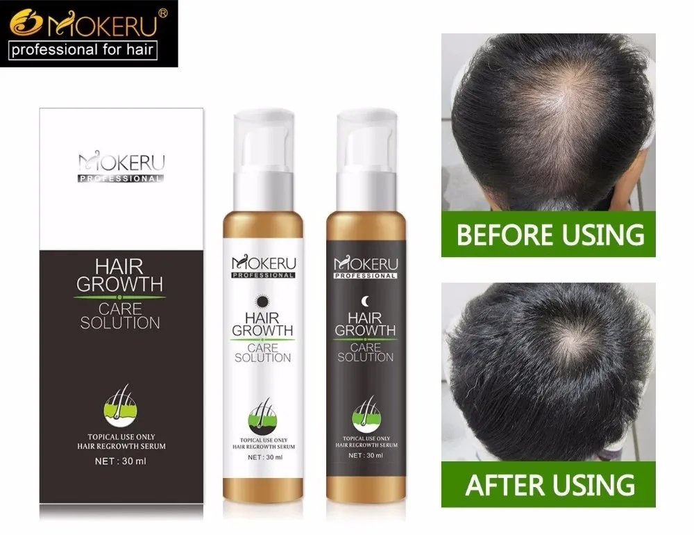 100% guaranteed hair grow cure hair balding and loss growth lotion  treatment spray bottle improve hair from roots magic removal