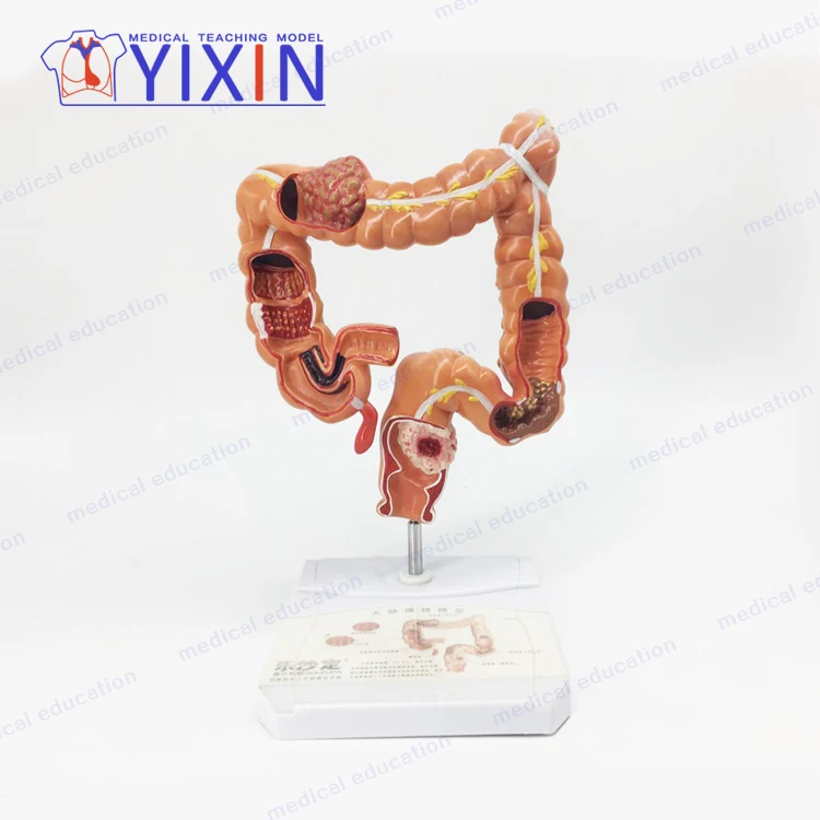 
YIXIN/Model of human colon disease Model of large intestine Pathological,Disease Large Intestines 