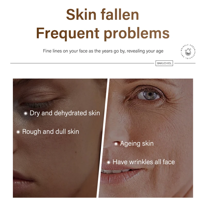 MOIKA Psoralen Phenol Anti-wrinkle Cream Desalination Fine-lines Acne Print Control Acne Compact Cream