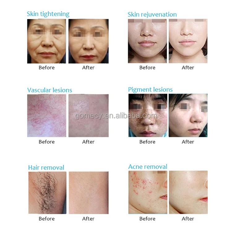 GOMECY-Multifunction-beauty-machine-3-in-1-elight-ipl-opt-rf-nd-yag-ipl-laser-hair-in-Beijing