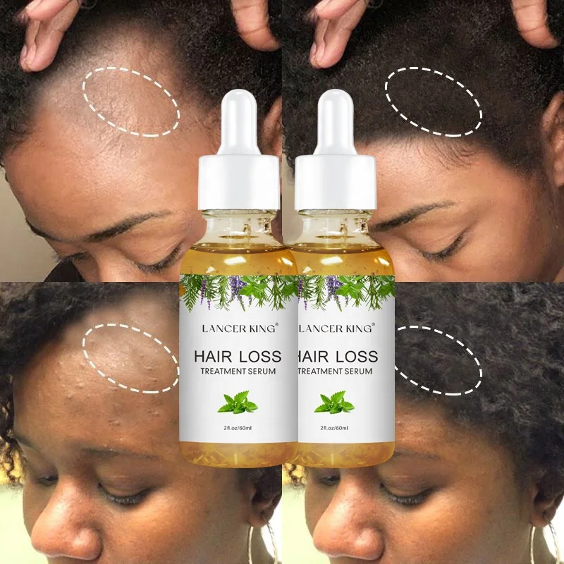 OEM 60ml Private Label Organic Formula Nourishing Scalp Elixirs Hair Care Loss Treatment Hair Growth Serum