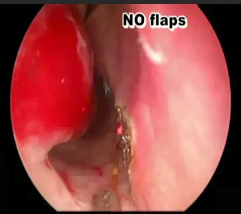 Concha bullosa treatment with laser system/ ENT surgical laser system