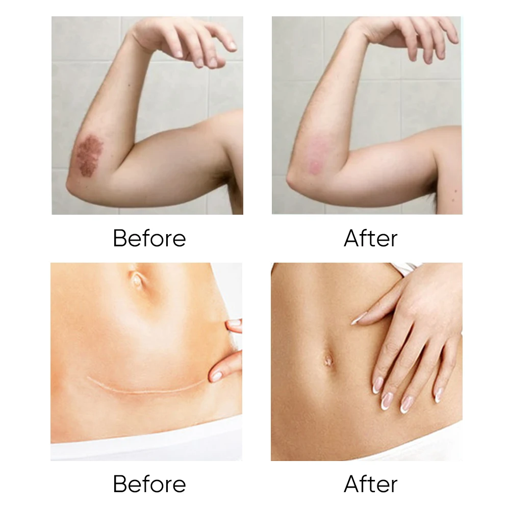 Private Label Fastest Scar Removal Gel Bruises Repair Reduce the Appearance of Most Types of Scars 50ml Removal Scar Gel