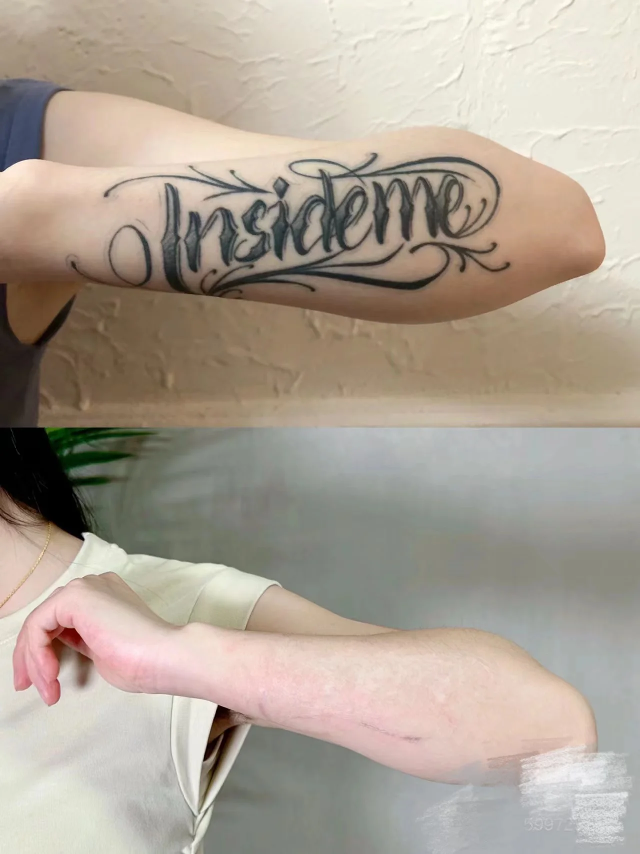 Pico laser machine 532nm 1064nm 1320nm tattoo removal acne treatment medical equipment